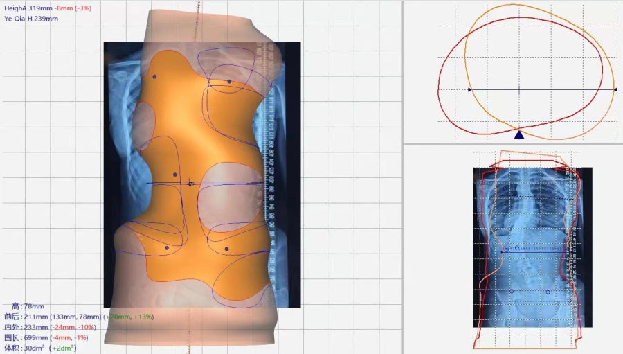 醫(yī)療案例 | 數(shù)字化三維掃描，為脊柱側(cè)彎患者“量身定制”矯形器